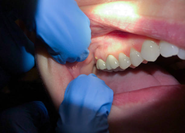 Best Emergency Denture Repair in Portage, WI