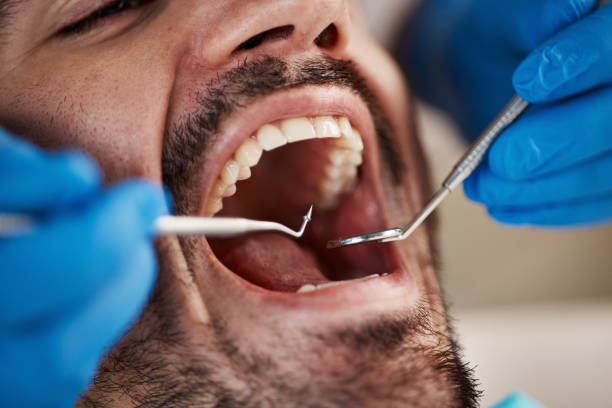 Best Emergency Tooth Extraction in Portage, WI